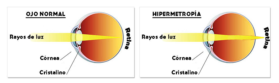 Stop Miopía Irun